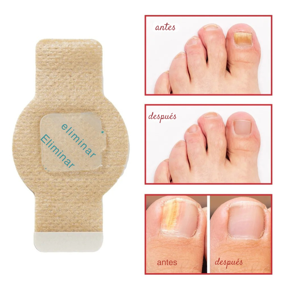 NailCure - Elimina los hongos en las uñas en 7 días